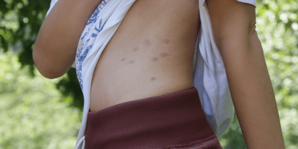 עקיצות פשפש המיטה - עקיצות פשפשים על גוף אישה - 52 מעלות